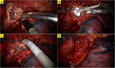 Double purse-string suture technique for circular-stapled anastomosis during robotic Ivor Lewis esophagectomy